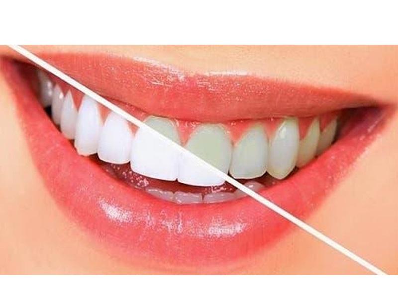 Blanqueamiento Dental